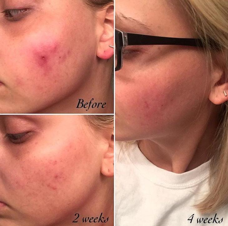 Timeless Organics 3-Step Acne System
