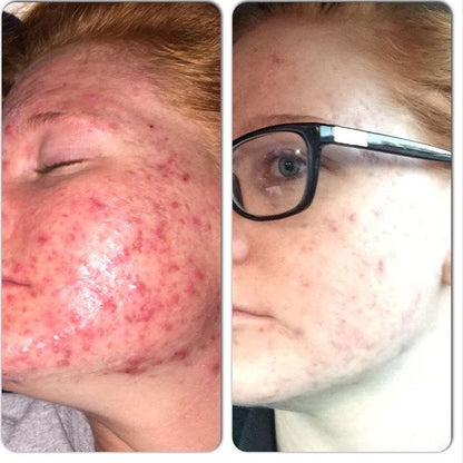 Timeless Organics 3-Step Acne System