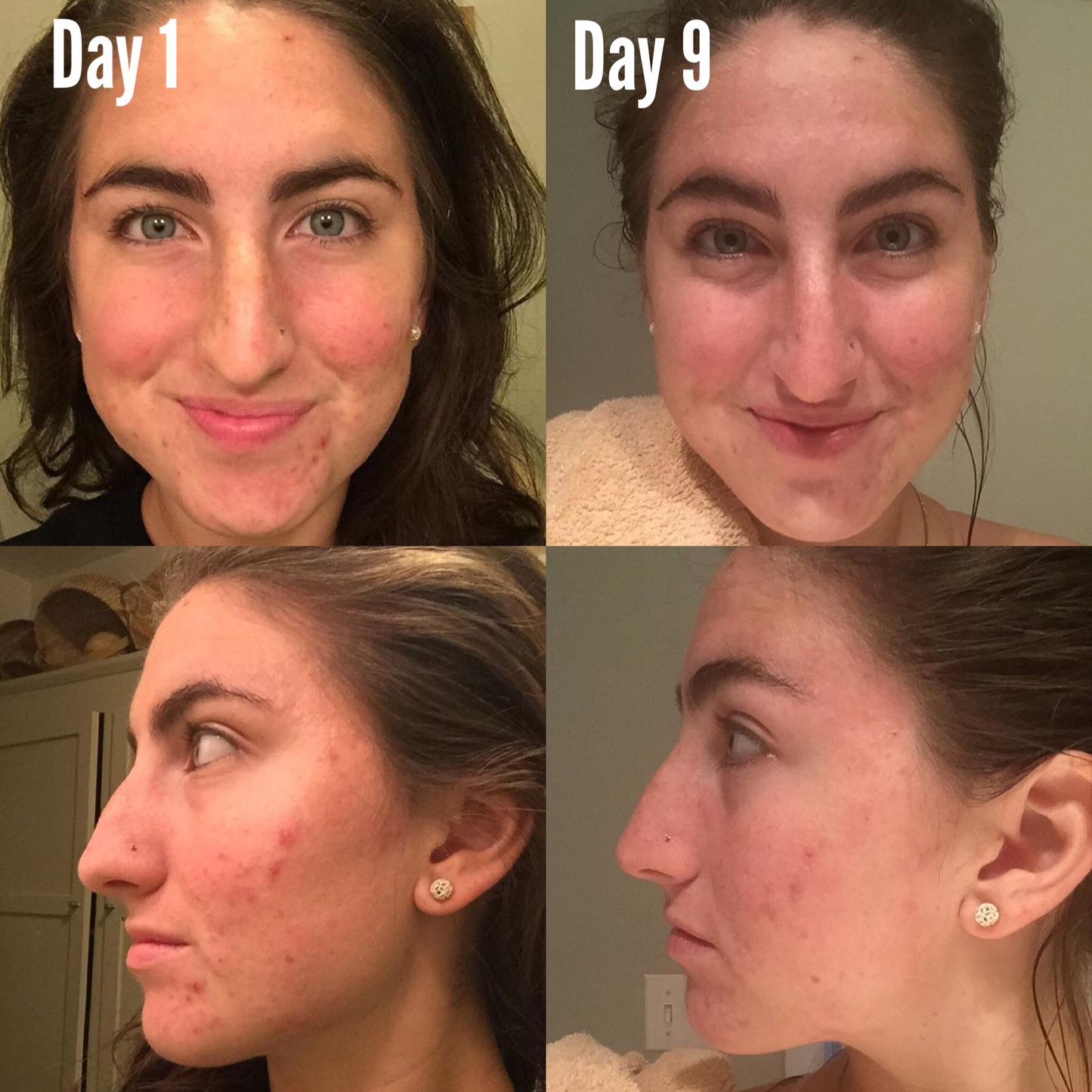 Timeless Organics 3-Step Acne System
