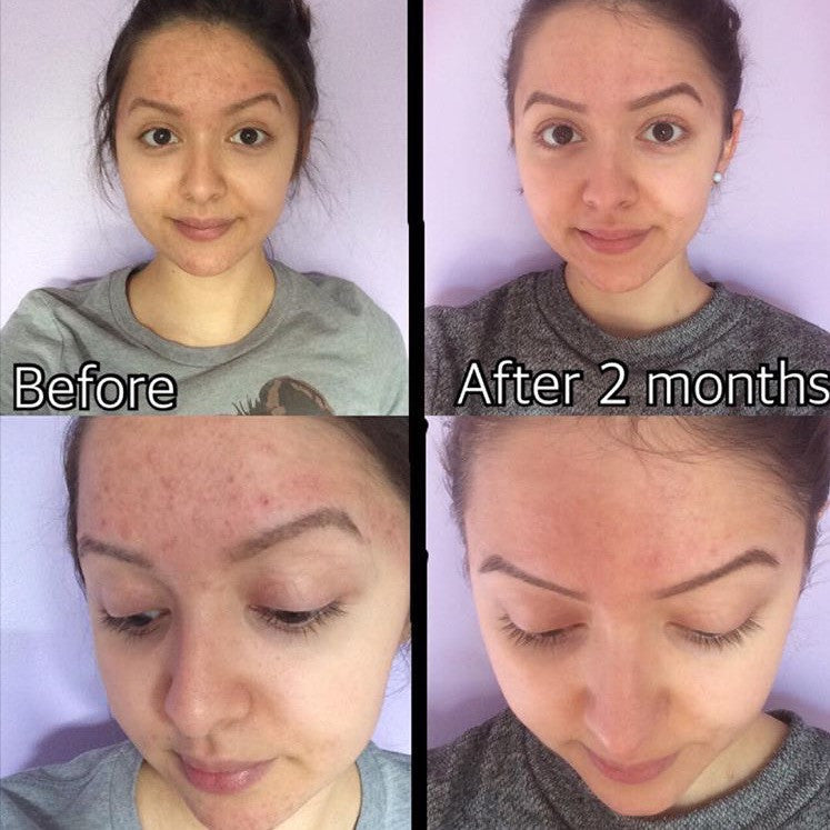 Timeless Organics 3-Step Acne System