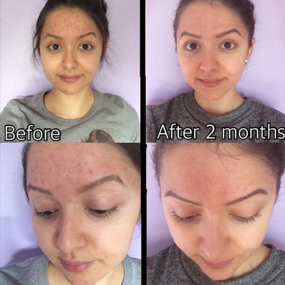 Timeless Organics 3-Step Acne System