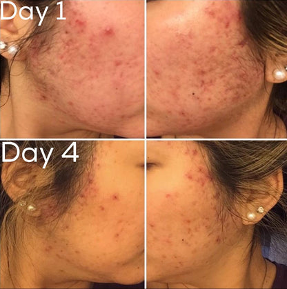 Timeless Organics 3-Step Acne System