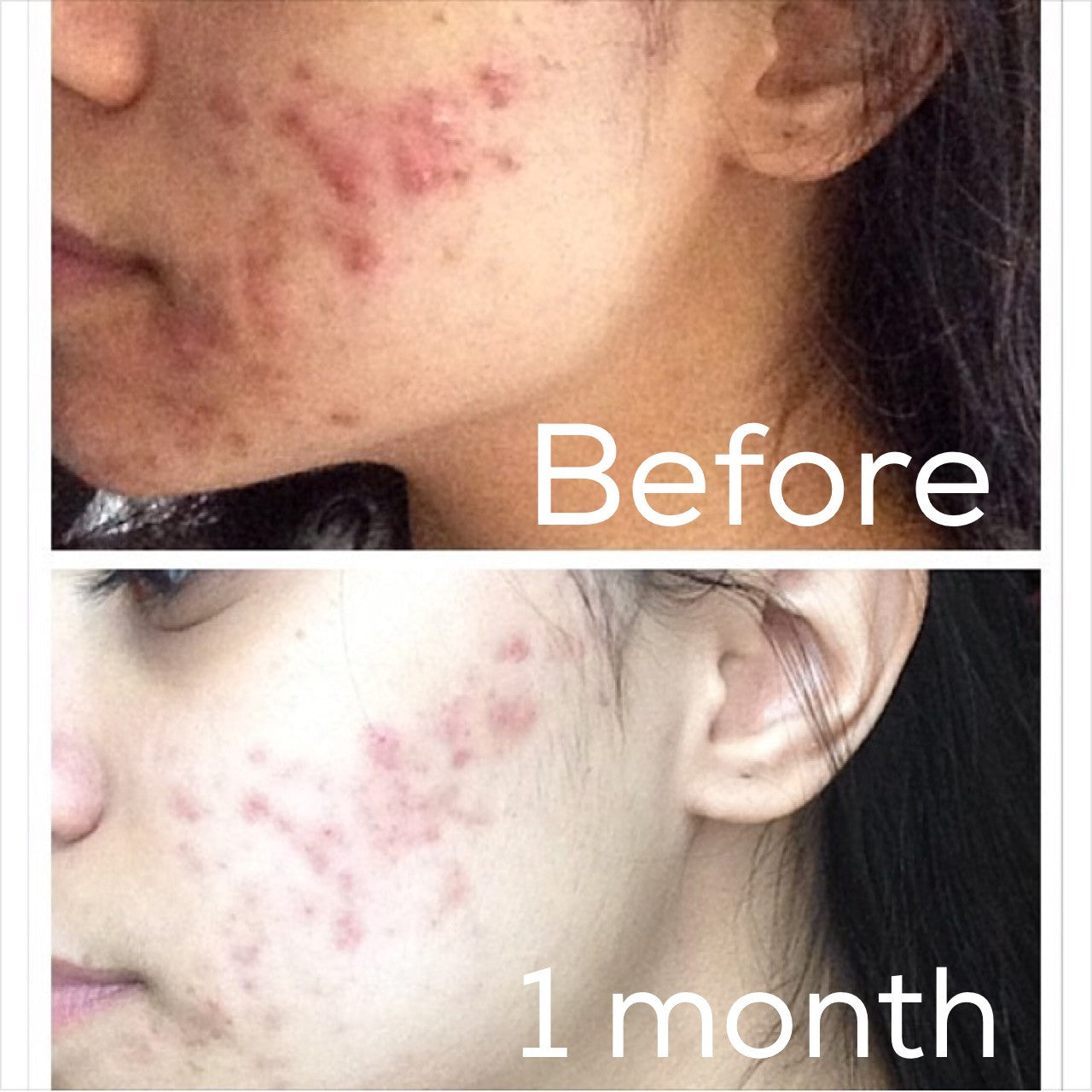 Timeless Organics 3-Step Acne System
